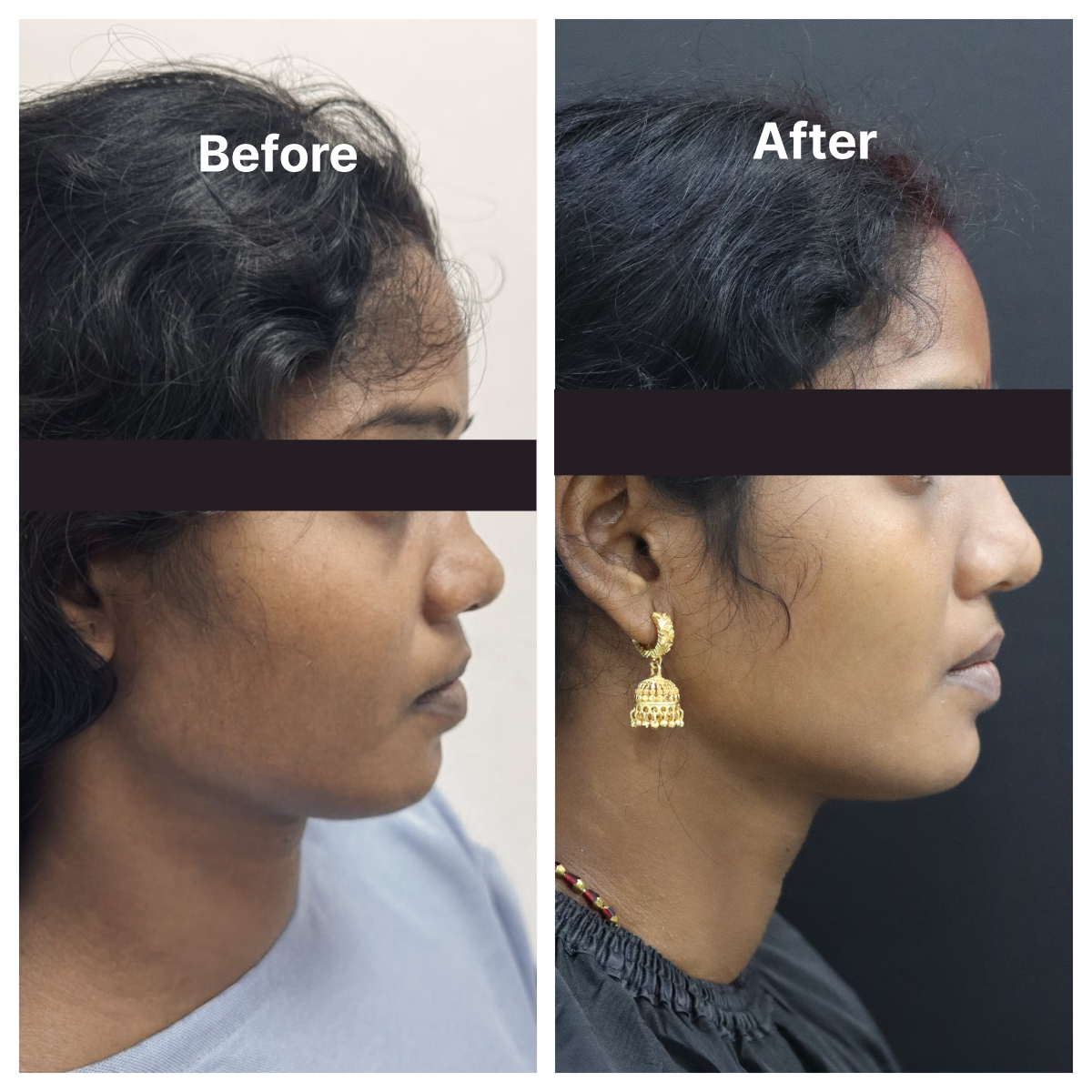 Alar Reduction result KOQ10